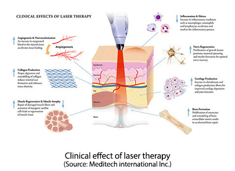 Clinical Effects Of Laser Therapy