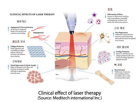 Clinical Effects Of Laser Therapy